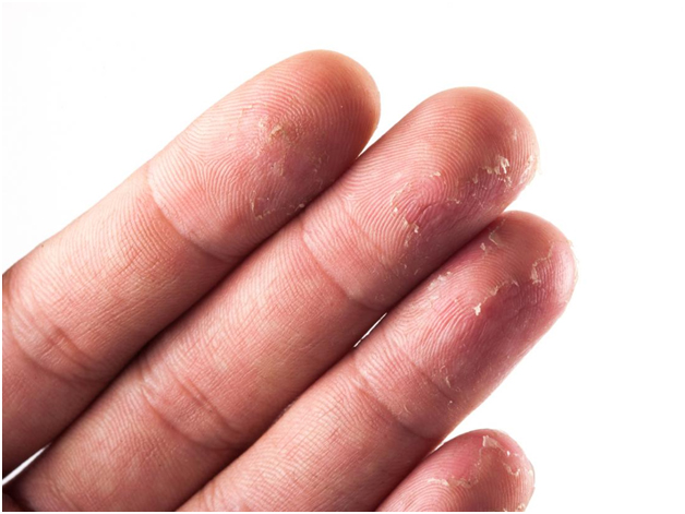درمان پوست پوسته شدن دست